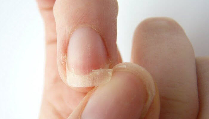 What Causes Brittle Nails?