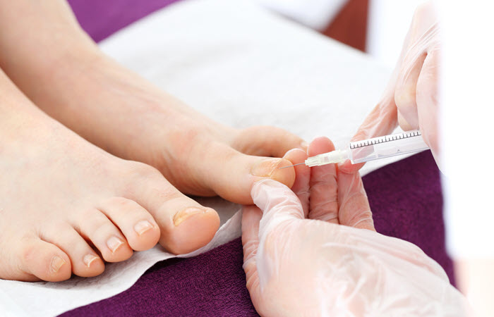 Nail Removal Surgery: What You Need to Know