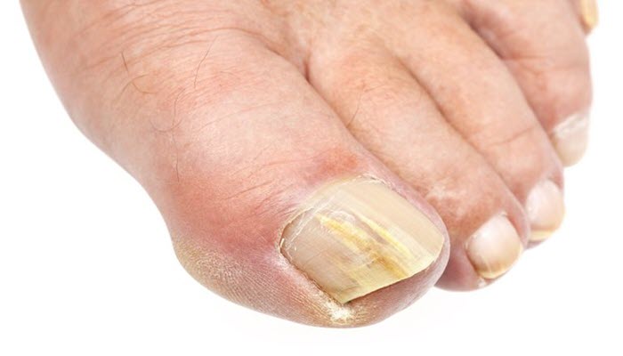 What Is The Best Treatment for Toenail Fungus
